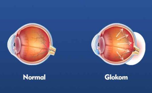 Glokom, genellikle bir veya her iki gözdeki yüksek basınçla ilişkili bir grup göz rahatsızlığıdır. Artan göz basıncı, optik sinire (gözü beyne bağlayan sinir) zarar verebilir ve bu da kalıcı görme kaybına neden olabilir.